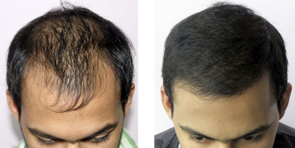 Растут жесткие волосы. Мезотерапия волос мужчин.