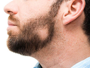 Проплешины на бороде: почему появляются и как их лечить - Миноксидил